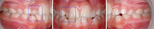 photo of cross bite - before treatment