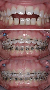 photo progression of orthodontic treatment using TADs